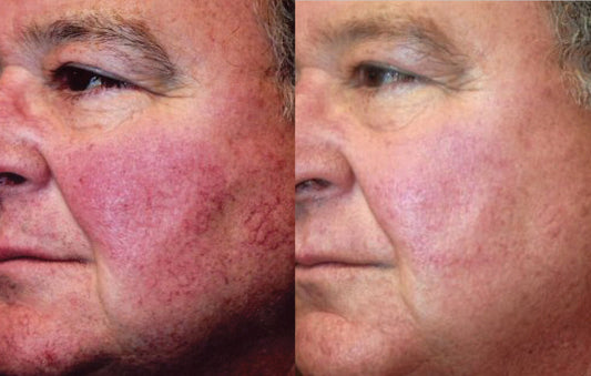 Does Red Light Therapy cause hyperpigmentation?