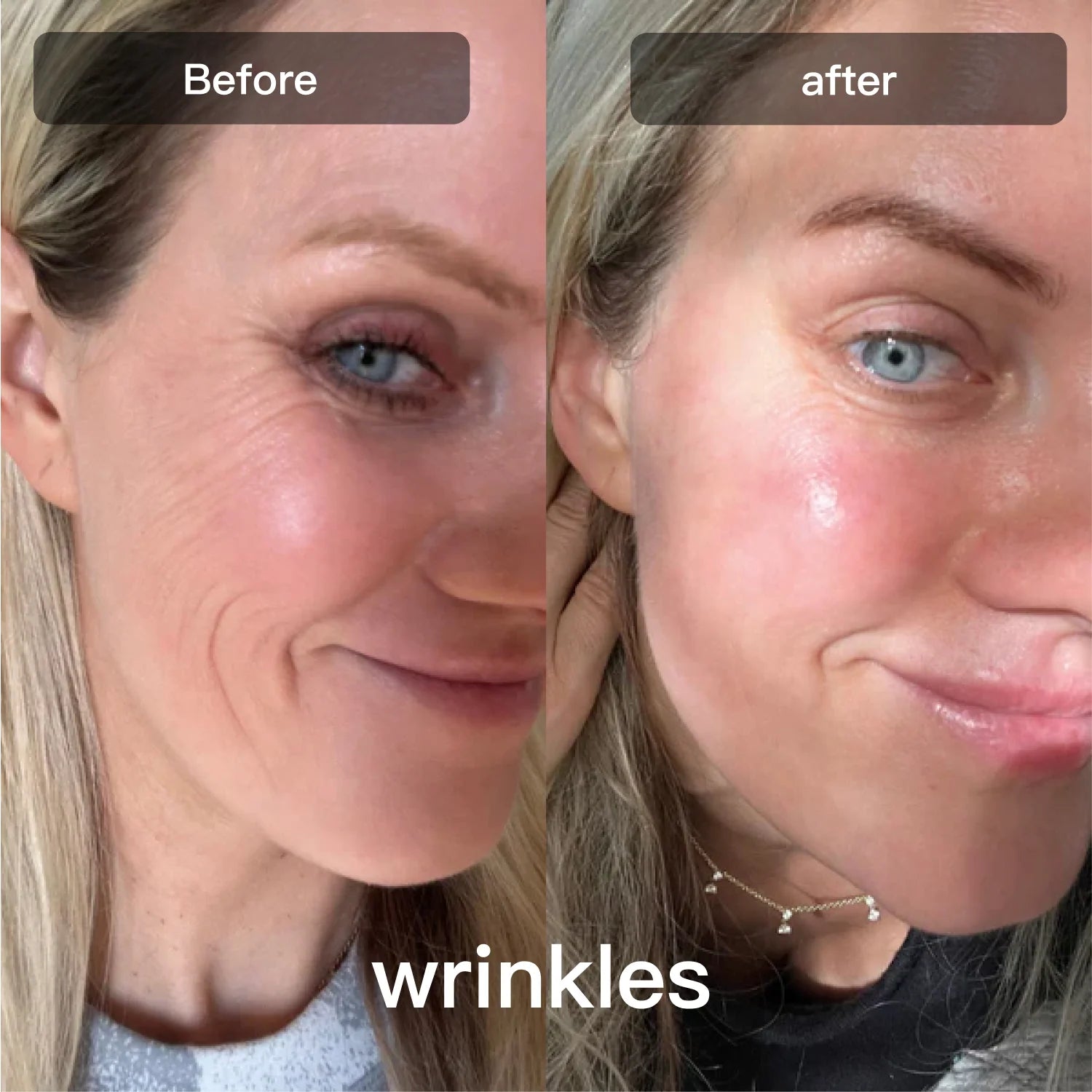 Friend Photon Skincare Device