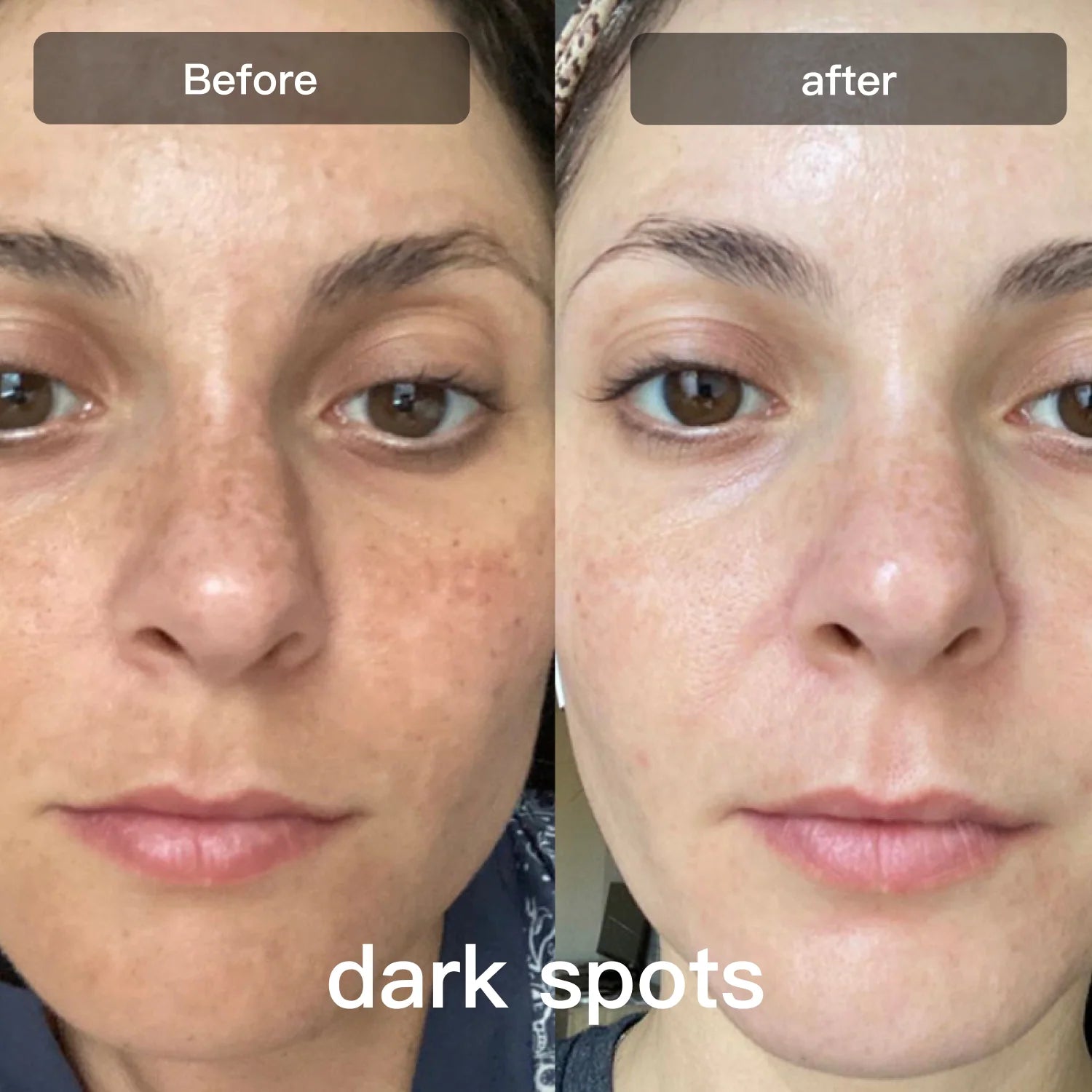 Friend Photon Skincare Device