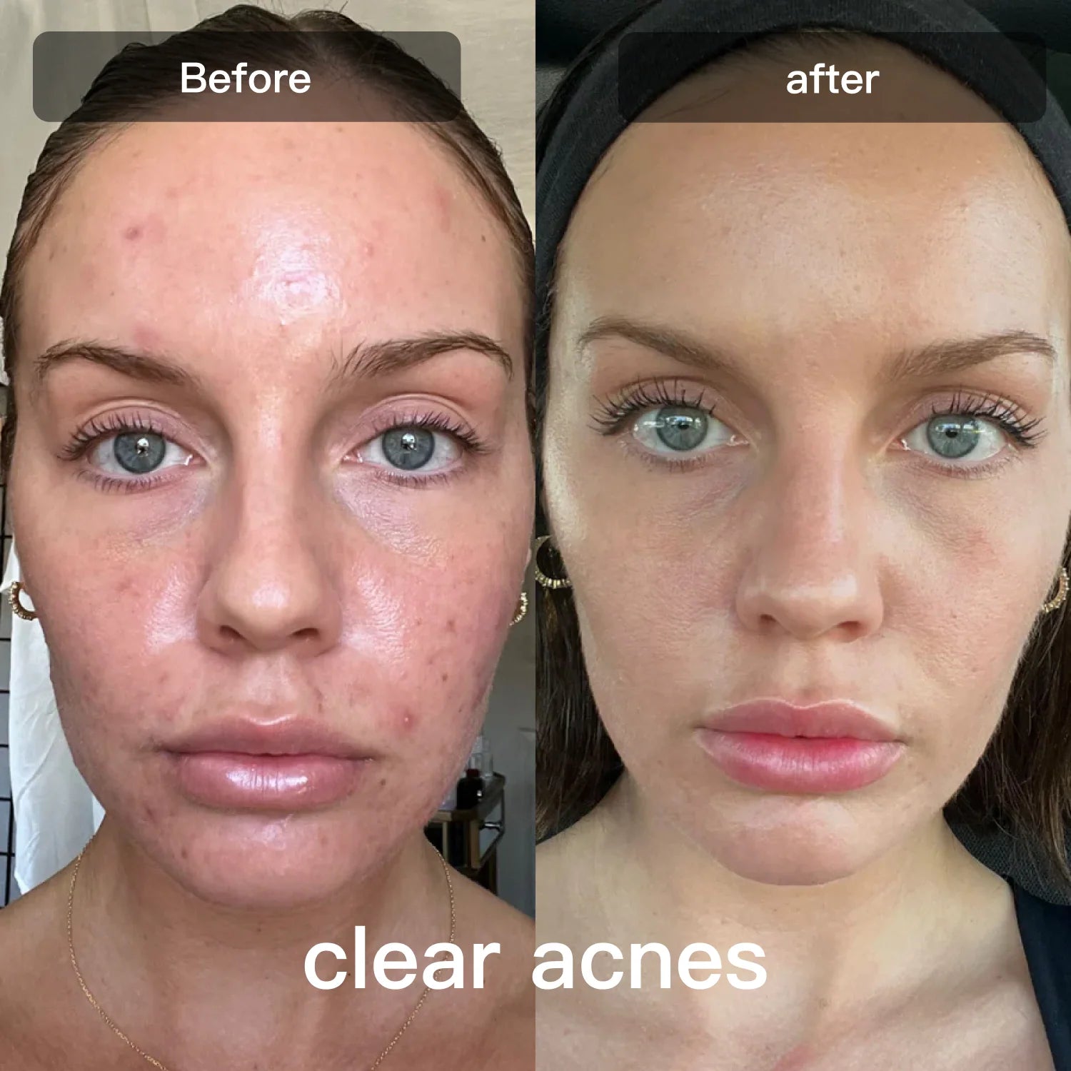 Friend Photon Skincare Device